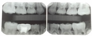 Molar incisor patient follow-up