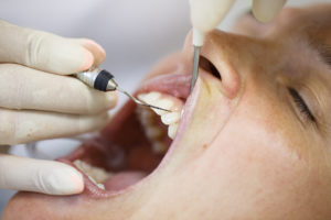 Periodontal probe for measuring pocket depths