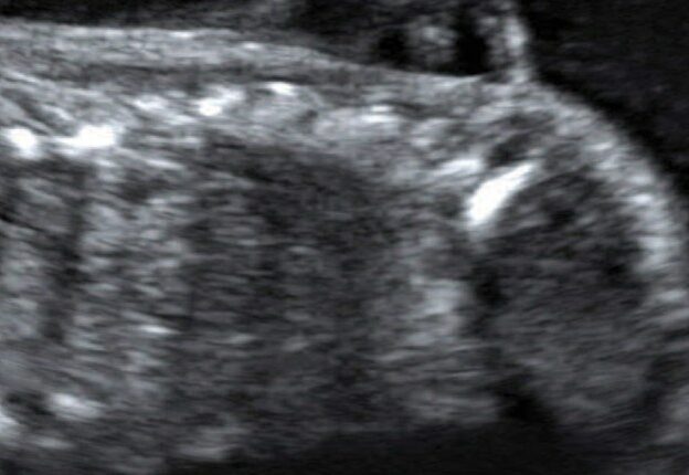 Oral Health Care for Patients With Spina Bifida course image