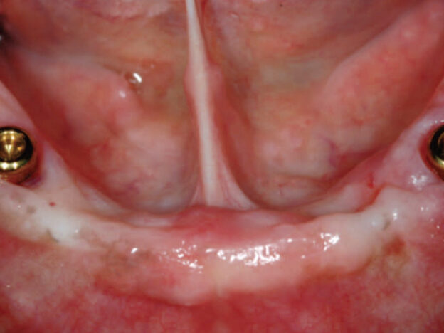 The Case for Implant-Retained, Tissue-Supported Overdentures course image