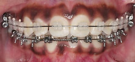 Firestone Ceramic Braces