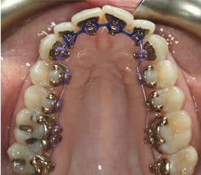 Firestone Ceramic Braces