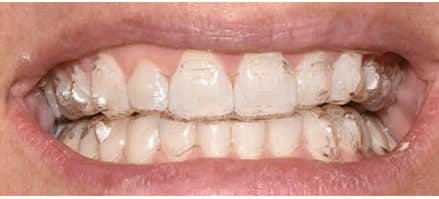 Esthetic Orthodontic Treatment - Decisions in Dentistry