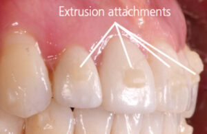 Attachements for orthodontic treatment