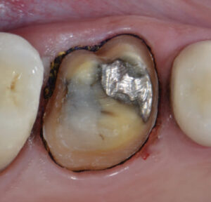 Gingival retraction method