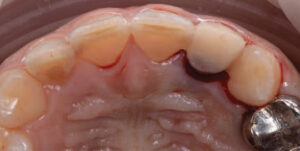 Provisional restoration