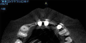 Buccal remaining in implant placement