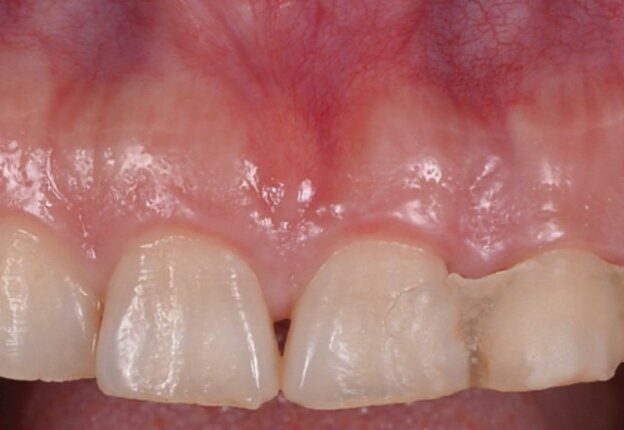 Strategies for Immediate Implant Placement course image