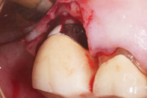 Retained excess cement found on the facial and distal aspects of the abutment. 