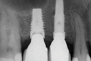 Implant site #3 was diagnosed with peri-implant mucositis.