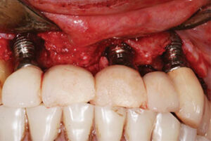 Teeth restored with a cement-retained bridge, implants sites were treated for peri-implantitis. 