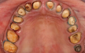 Maxillary preparations with deflection cords.