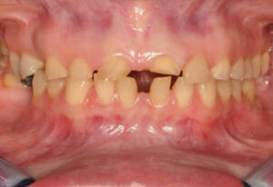 Pretreatment view prior to restorative treatment. 