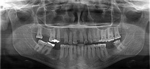 Panoramic pretreatment radiograph.