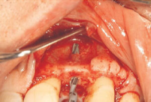 Buccal perforation. 