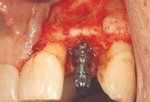 After implant placement. 