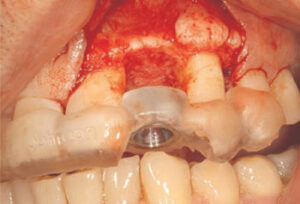 Tooth with surgical guide.