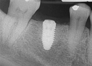 Postoperative radiograph of dental implant.