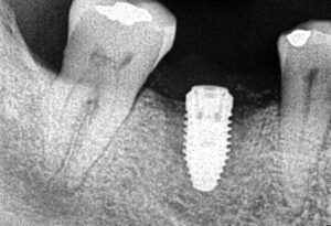 Peri-implant bone loss 