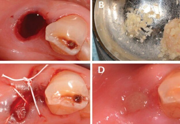 Alveolar Ridge Preservation With Open-Membrane Techniques course image