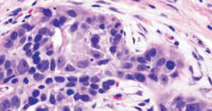 Oral mucosal lesions.