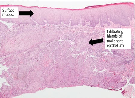 clinical presentation of oral mucosal lesions