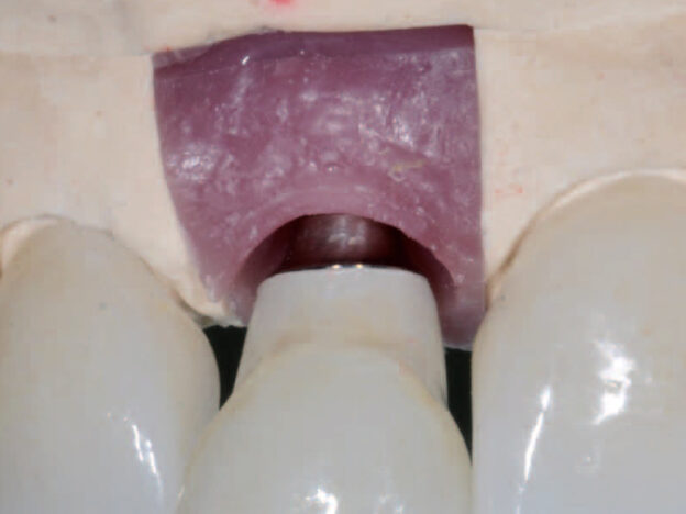 Clinical Considerations for Choosing Implant Abutment Connection Interfaces course image