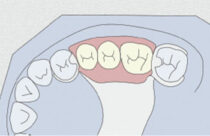 Removable partial denture