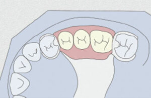 removable partial denture