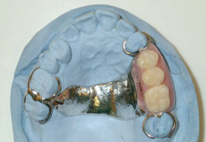 Premolar arch