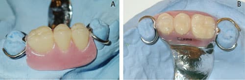 Esthetic Clasp Design For Removable Partial Dentures On Premolar Teeth Esthetic Clasp Design For Removable Partial Dentures On Premolar Teeth