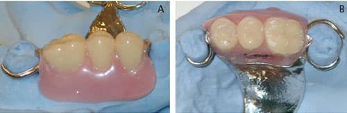 Esthetic Clasp Design for Removable Partial Dentures on Premolar Teeth ...