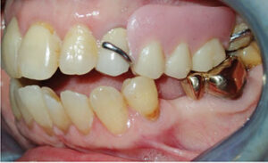 Premolar clasp