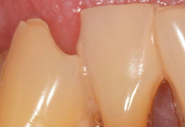 Erosive Tooth Wear: Etiology, Diagnosis, Risk Factors and Management course image