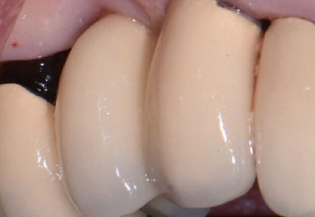 Avoiding and Managing Implant Complications course image