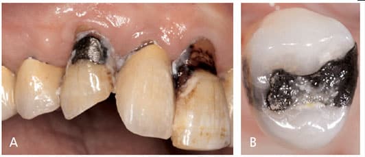 FACTS ABOUT TOOTH DECAY: DID YOU KNOW? – Smile Avenue