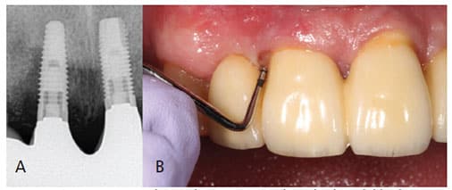 Treatment planning for the heavily compromised tooth by Stephen