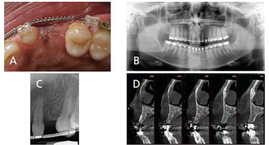 Treatment Planning Strategies For Dental Implant Procedures