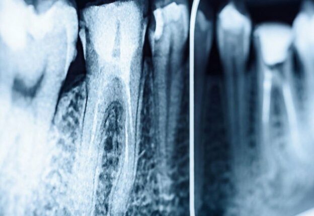 Managing Pain in Endodontic Therapy course image