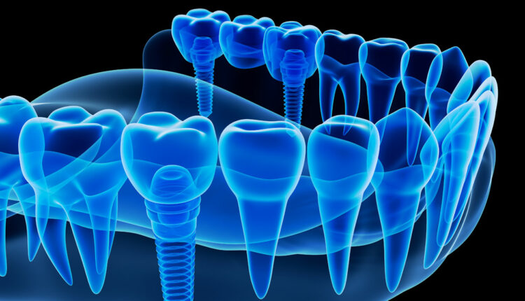 Dentist dental teeth teaching model showing titanium metal tooth implant  screw Stock Photo - Alamy