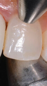 Dental implant process