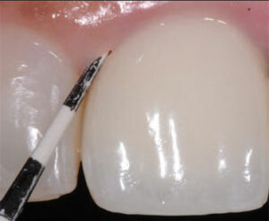 Examining peri-implant tissues