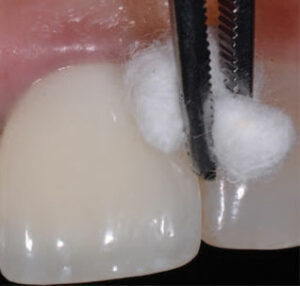 Cleaning the surface of an implant