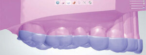 Occlusal guard