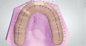Occlusal guard
