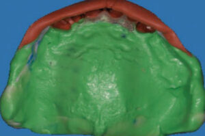 Maxillary impression