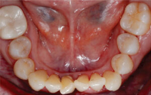 Photograph of mandibular arch