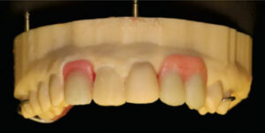Partial prosthesis