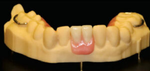 Partial prosthesis