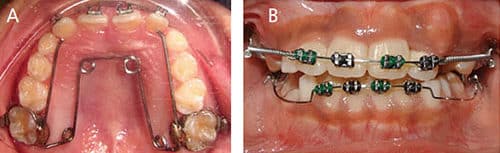 Management of Malocclusion In Children and Adolescents - Decisions in ...